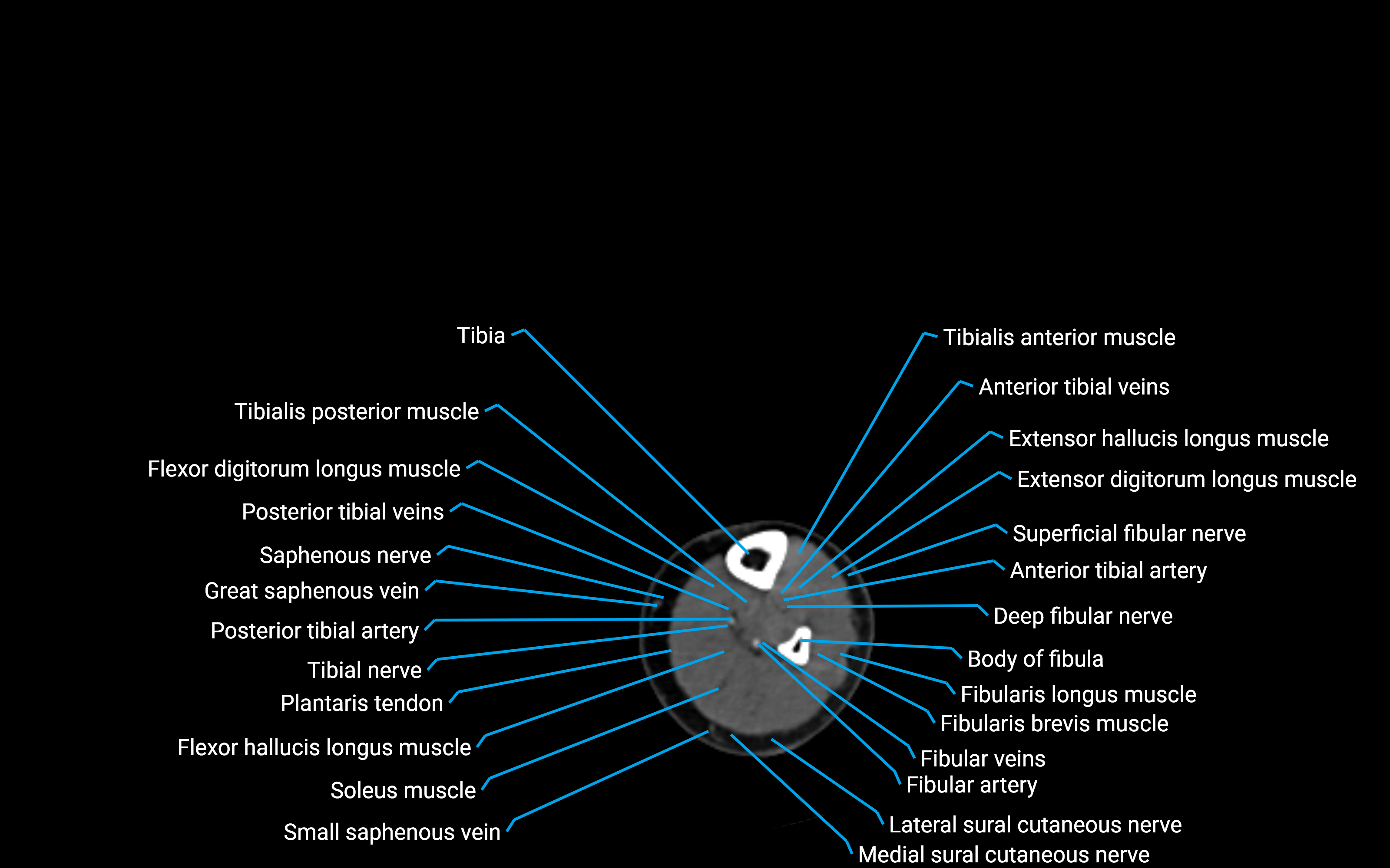 CT Lower leg axial cross sectional anatomy labelled image 130 (2).png